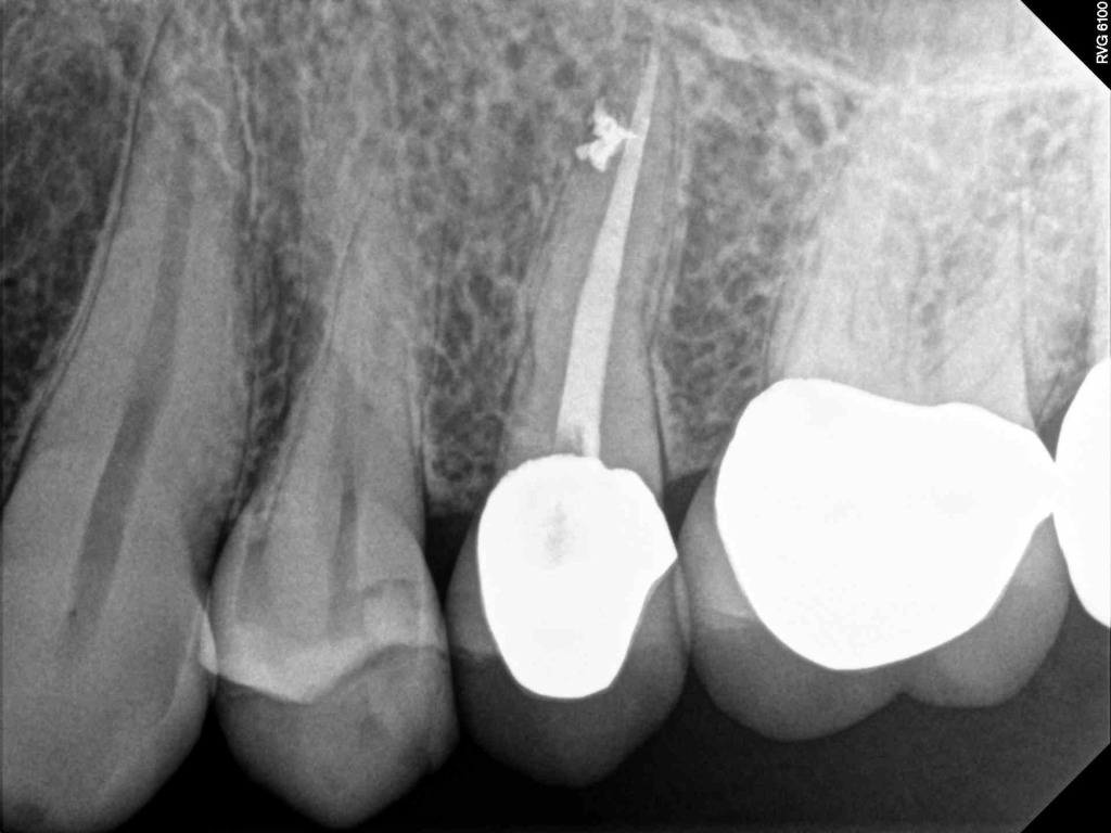 X Ray for Endodontic Work