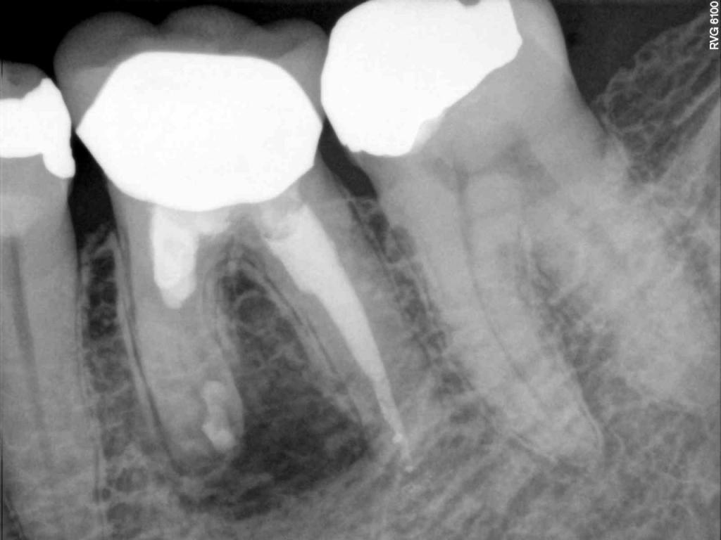 X Ray for Endodontic Work
