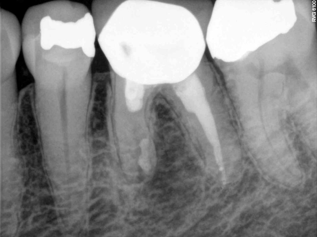 X Ray for Endodontic Work