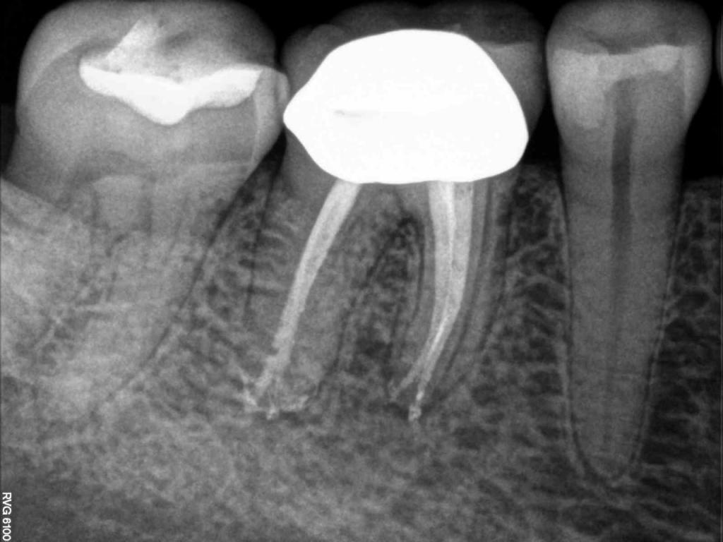 X Ray for Endodontic Work