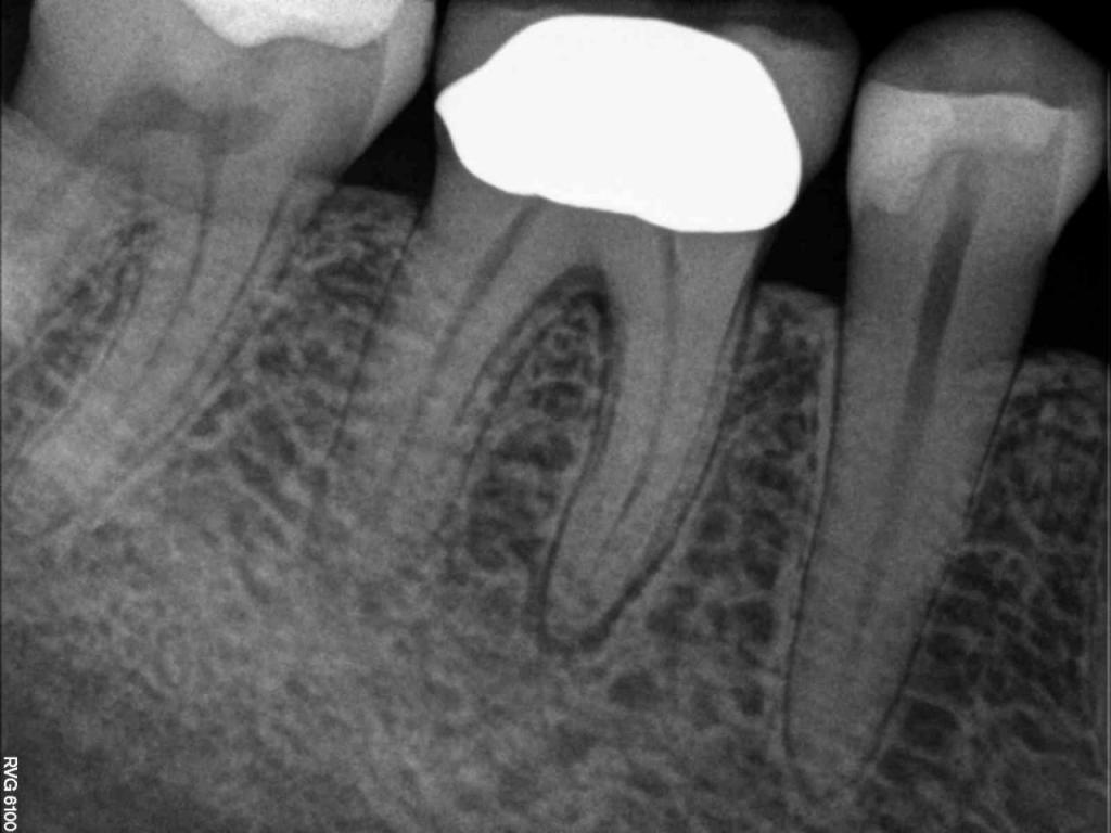 X Ray for Endodontic Work