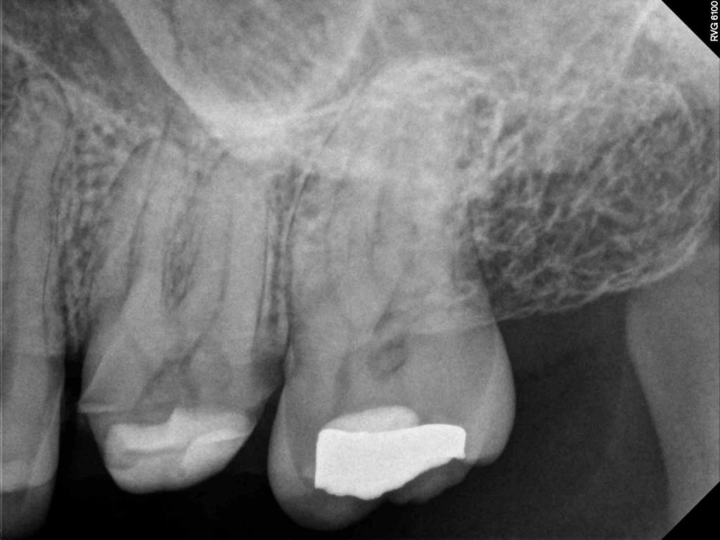 X Ray for Endodontic Work