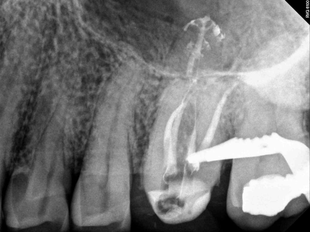 X Ray for Endodontic Work
