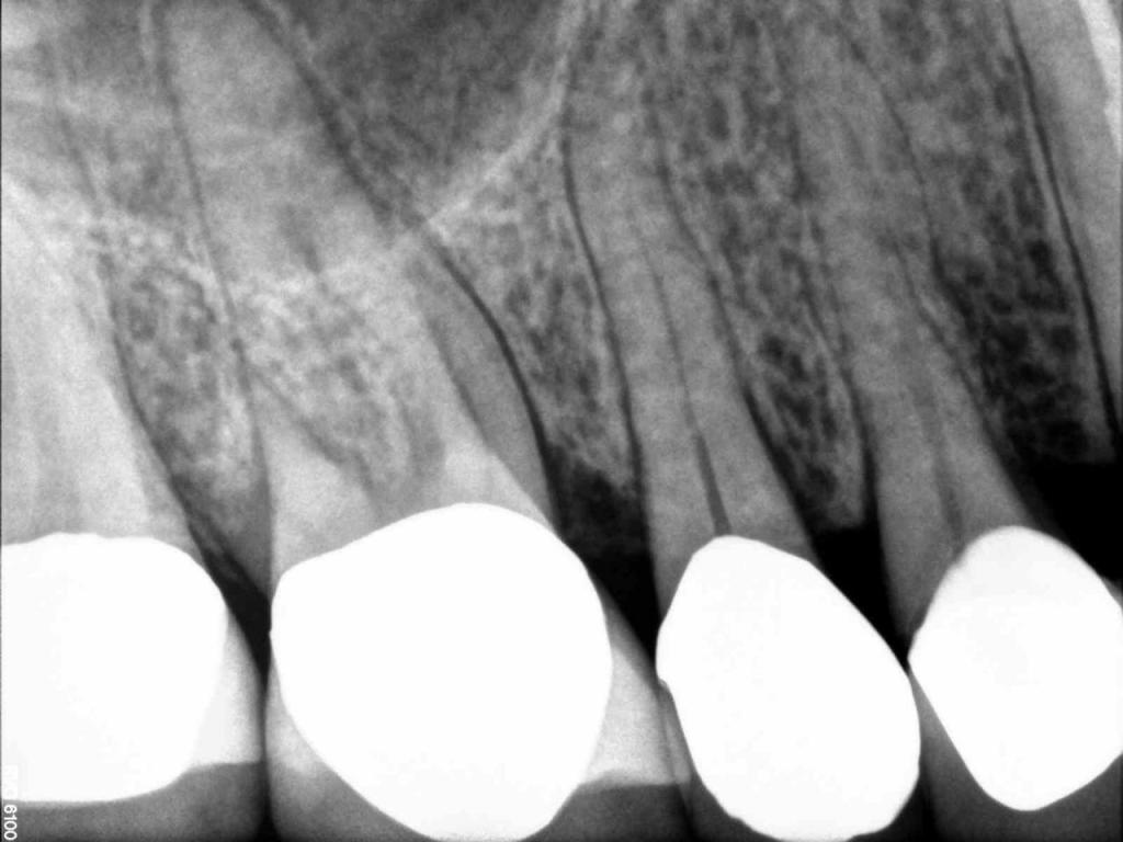 X Ray for Endodontic Work