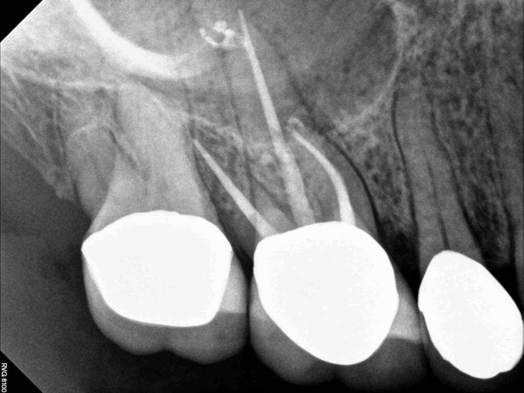 X Ray for Endodontic Work