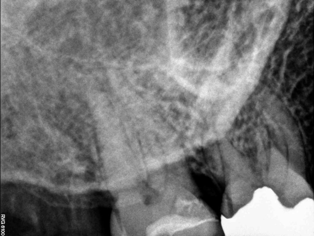 X Ray for Endodontic Work