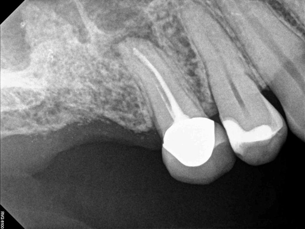 X Ray for Endodontic Work