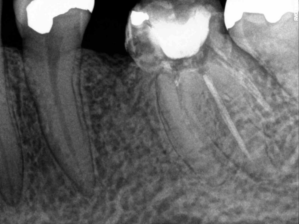 X Ray for Endodontic Work