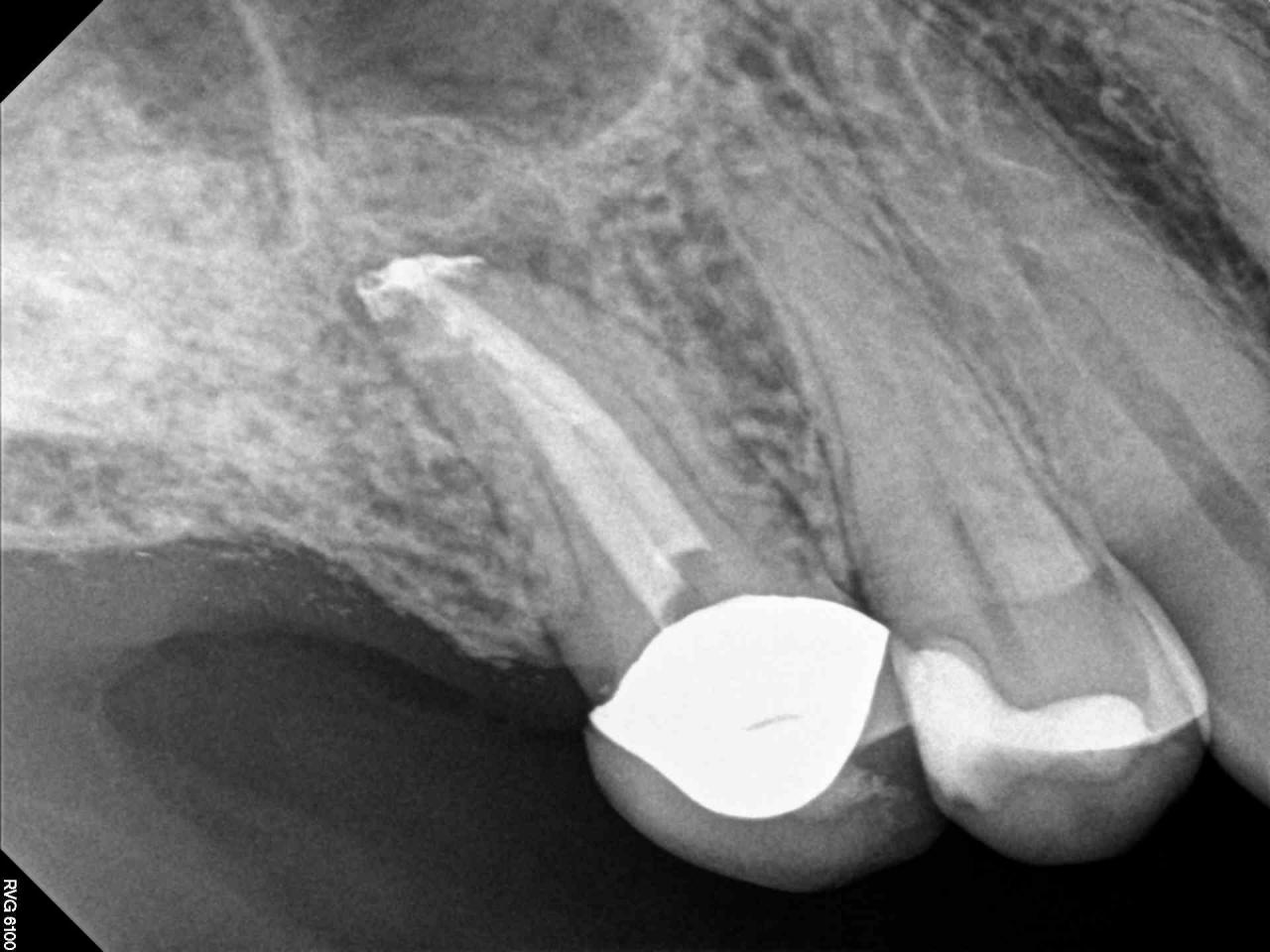 X Ray for Endodontic Work