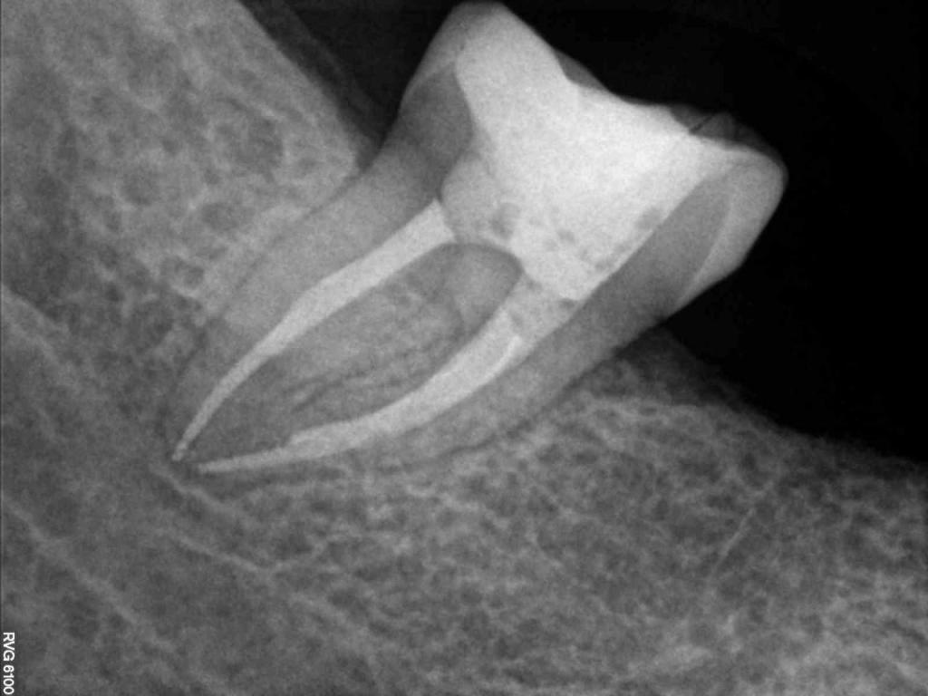X Ray for Endodontic Work
